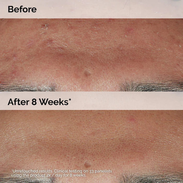 The Ordinary Niacinamide 10% + Zinc 1% Oil Control Serum